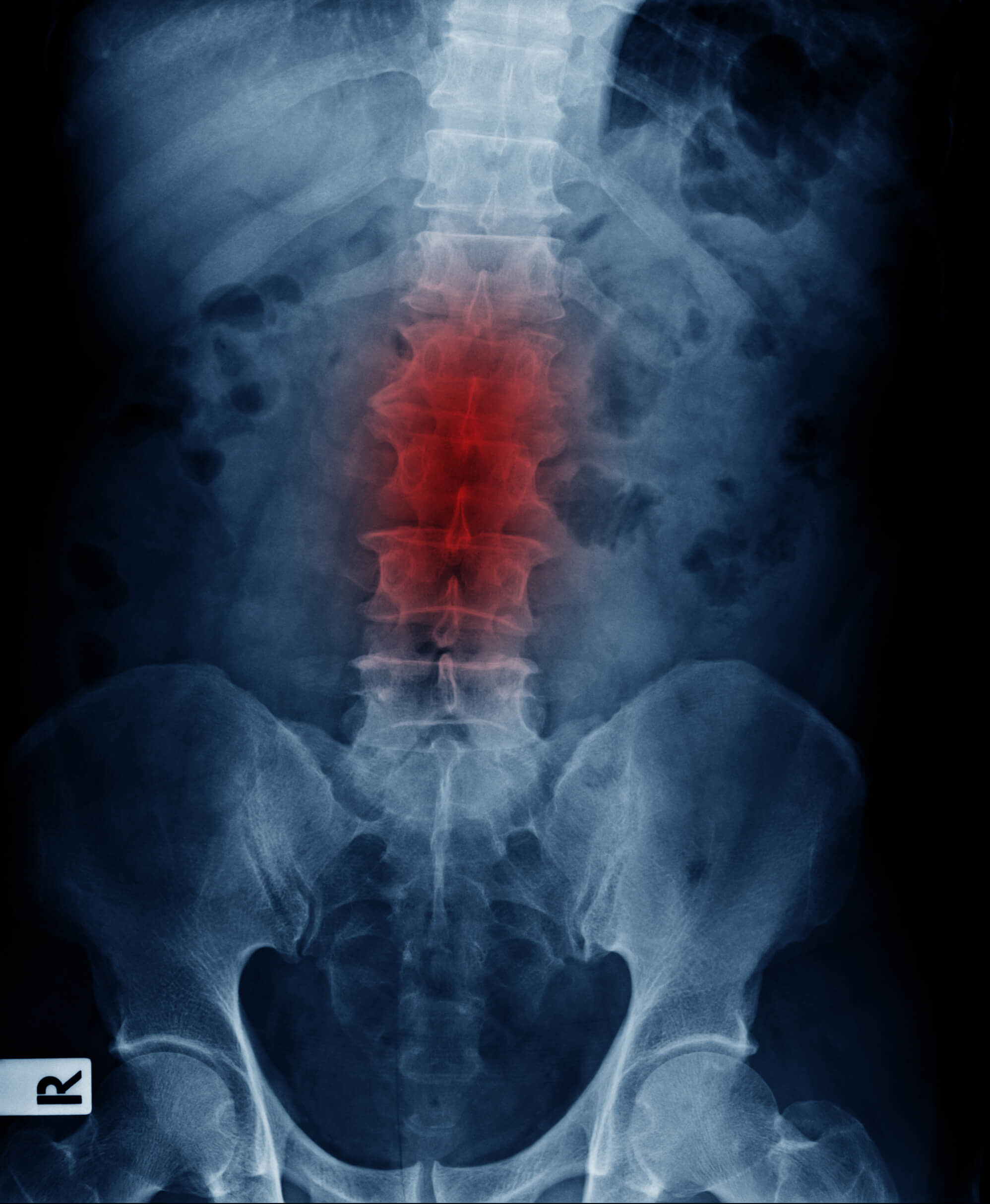 stem cell treatment spinal